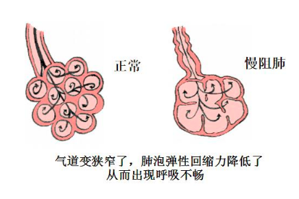 慢阻肺-肺病-慢性-呼吸障礙-咳嗽-咳痰-康復-肺功能檢測儀