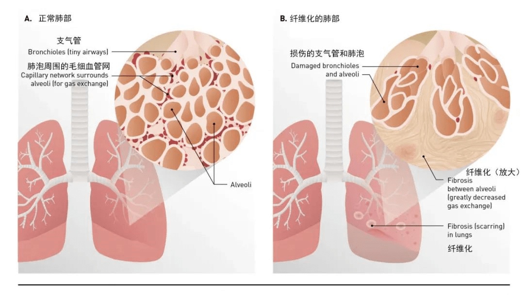 肺纖維化-肺炎-吸煙-特發性肺纖維化-肺功能-肺功能檢測儀-呼吸訓練器-慢阻肺-哮喘-免疫力-咽炎-咳嗽-干咳-呼吸肌